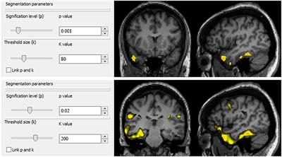 Epileptogenic Zone Localization With 18FDG PET Using a New Dynamic Parametric Analysis